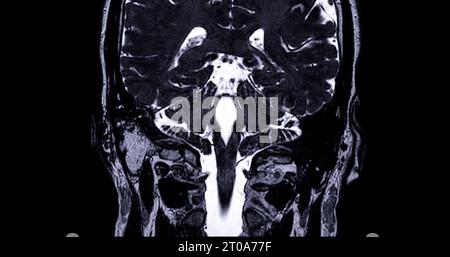 MRT-Untersuchung des inneren Gehörgangs (IAC). Stockfoto