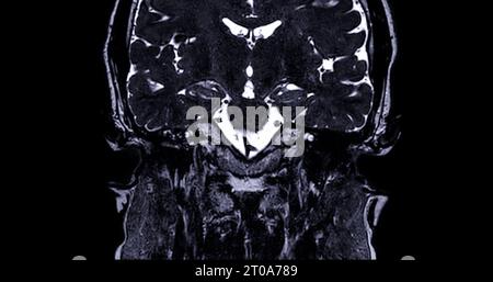 MRT-Untersuchung des inneren Gehörgangs (IAC). Stockfoto