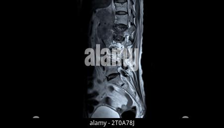 MRT L-S-Wirbelsäule oder sagittale T2-W-Ansicht der Lendenwirbelsäule zur Diagnose Rückenmarkkompression. Stockfoto