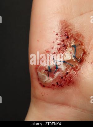 Genähte Handrisse nach dem Sturz. Weibliche Hand mit genähter Wunde im frühen Heilstadium. 3 Tage nach der Verletzung wurde gereinigt und genäht. Geschwollene Hand, Stockfoto