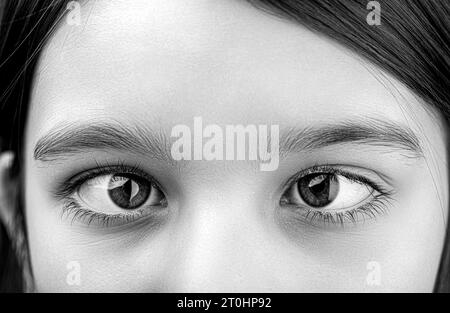 Schiele bei Kindern Ursachen, Behandlungskonzept. Weibliche Augen mit Strabismus. Hypertropie. Schiele. Schwarz-weiß Stockfoto