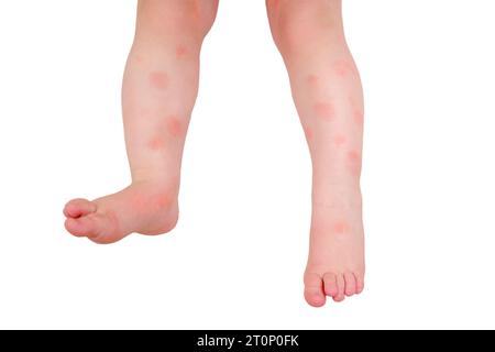 Kleinkinder Baby Hautpflege, Allergien und Dermatitis, isoliert auf weißem Hintergrund. Rote Allergieflecken und atopische Dermatitis auf der Kinderhaut, isoliert Stockfoto