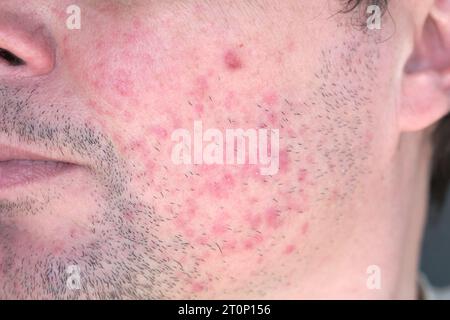 Dermatitis im Gesicht des Mannes. Ekzem Nahaufnahme. Stockfoto