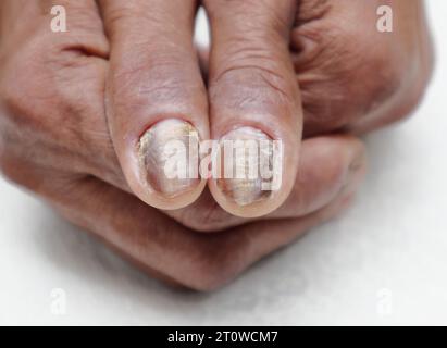 Nahaufnahme der verwöhnten Handnägel einer älteren asiatischen Diabetikerin Stockfoto