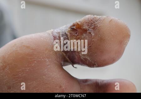 Ein diabetisches Fußulkus in einem großen Zeh heilt langsam aus der Nähe Stockfoto