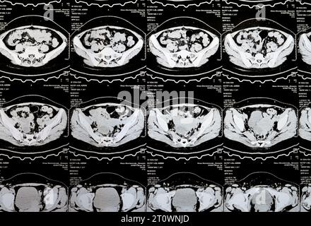 Kairo, Ägypten, 3. Oktober 2023: Mehrschicht-CT-Scan Abdomen und Becken zeigt rechte Ovarialzyste 3 x 3 cm, gasförmige Distension des Kolons, keine nennenswerte Harnmenge Stockfoto