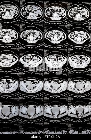 Kairo, Ägypten, 3. Oktober 2023: Mehrschicht-CT-Scan Abdomen und Becken zeigt rechte Ovarialzyste 3 x 3 cm, gasförmige Distension des Kolons, keine nennenswerte Harnmenge Stockfoto