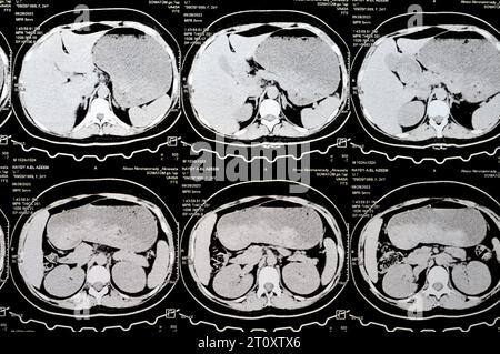 Kairo, Ägypten, 3. Oktober 2023: Mehrschicht-CT-Scan Abdomen und Becken zeigt rechte Ovarialzyste 3 x 3 cm, gasförmige Distension des Kolons, keine nennenswerte Harnmenge Stockfoto