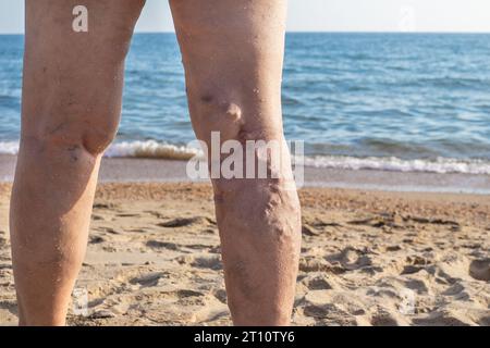 Weibliche Schmerzen an den Beinen mit ausbuchenden Venen entlang der Rückseite des Unterschenkels. Krampfadern bei Frauen. Stockfoto