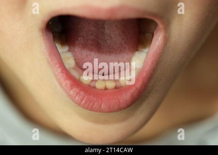 Die bleibenden Zähne eines Kindes wachsen neben den Zähnen des Babys, die nicht herausgefallen sind. Zweite Zahnreihe. Zahnheilkunde. Ein medizinisches Konzept. Zahnwechsel. Stockfoto