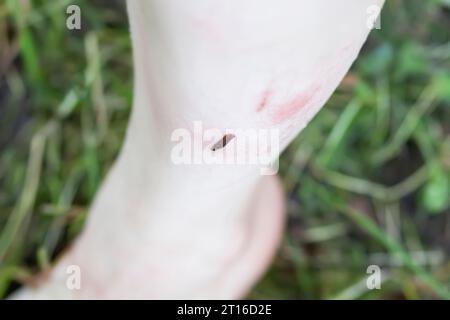 Ein Blutegel beißt einer Frau das Bein. Stockfoto