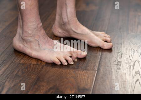 Die deformierten Hammerhöhlen des Mannes zeigen den linken Fuß ein Jahr nach der Operation Stockfoto