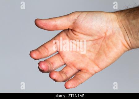 Hand mit Kontaktdermatitis in einem Finger Stockfoto