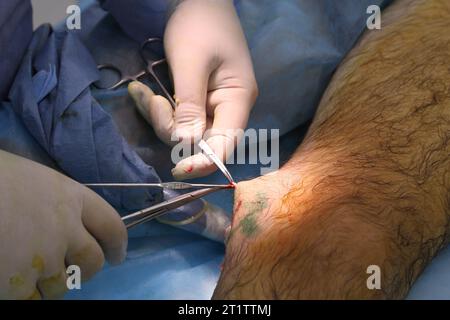 Medizinische Chirurgie bei endovenöser Laserphotokoagulation der Vena saphena magna. Miniphlegektomie. Endovenöse Lasergerinnungsvene. Stockfoto