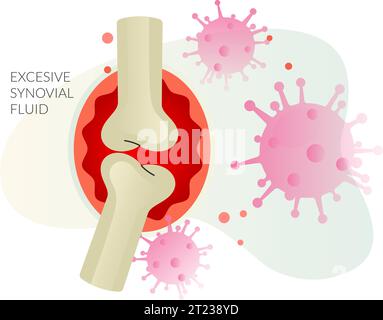 Entzündung - Gelenkschmerzen - rheumatoide Arthritis als Stockbild in EPS 10 Datei Stock Vektor