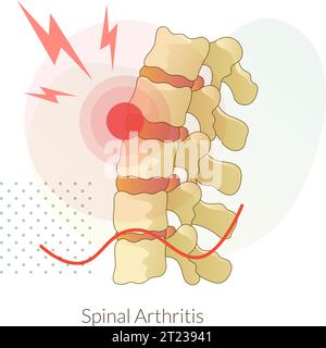 Rückenschmerzen - Wirbelsäulenarthritis - Stock-Symbol als EPS 10-Datei Stock Vektor
