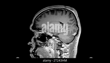 MRT-Hirnsagittal t1w mit Gadolinium, das normales Gehirn zeigt. Stockfoto