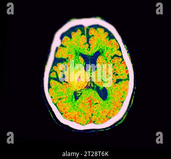 CT Brain Perfusion oder CT-Scan der axialen Ansicht des Gehirns, die den zerebralen Blutfluss auf dem Monitor im Schlaganfallbereich zeigt. Stockfoto