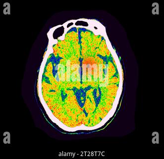 CT Brain Perfusion oder CT-Scan der axialen Ansicht des Gehirns, die den zerebralen Blutfluss auf dem Monitor im Schlaganfallbereich zeigt. Stockfoto