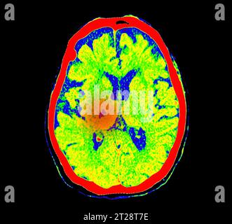 CT Brain Perfusion oder CT-Scan der axialen Ansicht des Gehirns, die den zerebralen Blutfluss auf dem Monitor im Schlaganfallbereich zeigt. Stockfoto