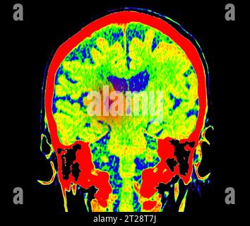 CT Brain Perfusion oder CT-Scan der axialen Ansicht des Gehirns, die den zerebralen Blutfluss auf dem Monitor im Schlaganfallbereich zeigt. Stockfoto