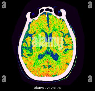 CT Brain Perfusion oder CT-Scan der axialen Ansicht des Gehirns, die den zerebralen Blutfluss auf dem Monitor im Schlaganfallbereich zeigt. Stockfoto