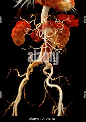 CTA Aorta abdominalis mit 3D-Rendering der abdominalen Aortendissektion. Stockfoto