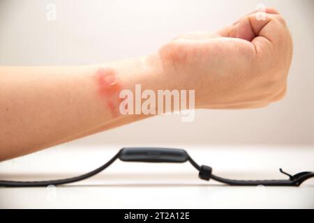 Rötungen und Allergien am Handgelenk einer Person durch das Tragen eines Fitnessarmbands mit Silikonband. Kontaktdermatitis Stockfoto