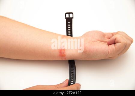 Rötungen und Allergien am Handgelenk einer Person durch das Tragen eines Fitnessarmbands mit Silikonband. Kontaktdermatitis Stockfoto