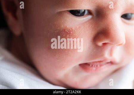 Allergische Pickel bei einem Neugeborenen im Gesicht. Pathogenese, Akne des Neugeborenen, Nahaufnahme Stockfoto