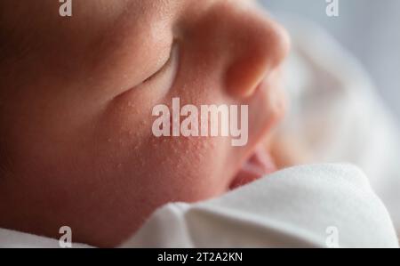 Pickel im Gesicht eines Neugeborenen. Babys Anpassung an die Umwelt. Stockfoto