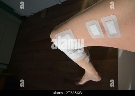 Die Ergebnisse der Krampfaderchirurgie im Nahanblick eines menschlichen Beines, das mit dem Krampfaderlaser der neuesten Generation behandelt wurde. Moderner Ansatz Stockfoto