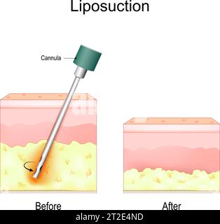 Das Liposuktionsverfahren. Vorher und nachher. Fettentfernung und Kosmetische Chirurgie. Fettabsaugung zur Gewichtsabnahme. Vektorabbildung Stock Vektor