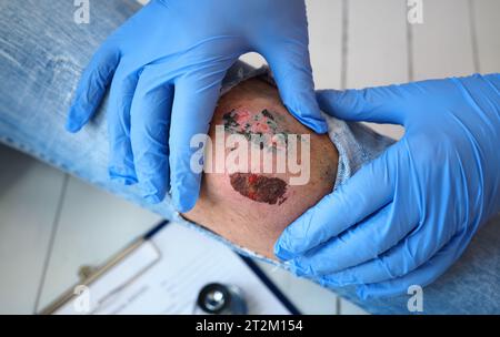 Der Arzt untersucht die heilende Wunde des Patienten am Bein der Kniescheibe zerrissene Jeans Stockfoto