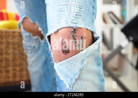 Wunde am Knie zerrissen Jeans Hosen Stockfoto