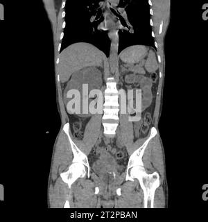 Polyzystische Nierenerkrankung, CT-Scan Stockfoto