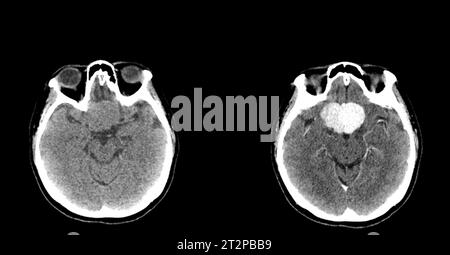 Sellarmasse, CT-Scan Stockfoto