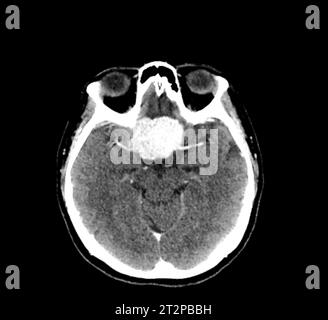 Sellarmasse, CT-Scan Stockfoto