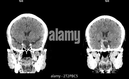 Sellarmasse, CT-Scan Stockfoto