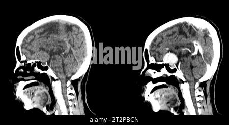 Sellarmasse, CT-Scan Stockfoto