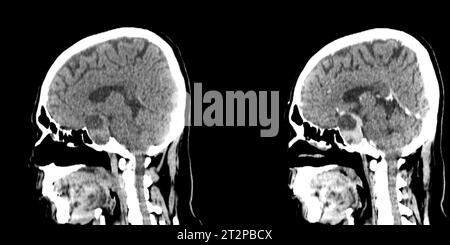 Sellarmasse, CT-Scan Stockfoto