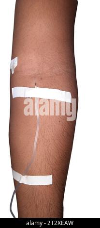 Männlicher Patient, der im Krankenhaus Infusionstherapie erhält, Venenkatheter in die Armvene einführen, isolierter weißer Hintergrund Stockfoto