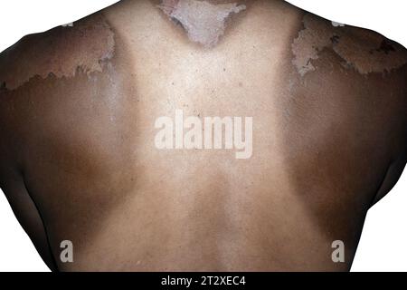 Sonnenbrand auf dem Rücken eines Mannes. Starke Bräune im Mann. Rote Hände und Rücken. Wunde Haut, Blasenbildung. Kein Sonnenschutz, isolierter weißer Hintergrund Stockfoto
