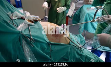 Adipositas-Chirurgie. Die Operation zur Gewichtsreduktion wird mit laparoskopischen Operationen durchgeführt. Operationsarzt und Operationsteam Stockfoto