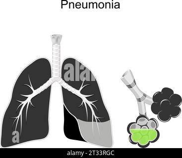 Pneumonie. Querschnitt menschlicher Lungen, Bronchien und Alveolen mit grüner Flüssigkeit respiratorischer Infektion. Schwarz-weiß Vektorillustration über Pneumo Stock Vektor