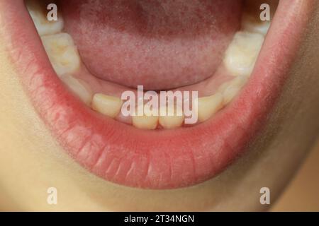 Die bleibenden Zähne eines Kindes wachsen neben den Zähnen des Babys, die nicht herausgefallen sind. Zweite Zahnreihe. Zahnheilkunde. Ein medizinisches Konzept. Zahnwechsel. Schließen Stockfoto
