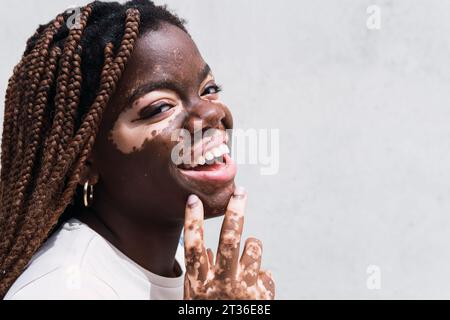 Glückliche junge Frau mit Vitiligo und Depigmentierung vor weißer Wand Stockfoto