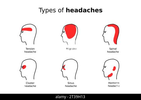Arten von Kopfschmerzen. Einfache Infografik. Vektorillustration Gesundheitskonzept. Stock Vektor