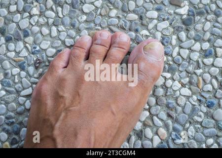 Zehennägel mit Pilzproblemen,Onychomykose, auch bekannt als Tinea unguium, ist eine Pilzinfektion des Nagels, Steinhintergrund. Stockfoto