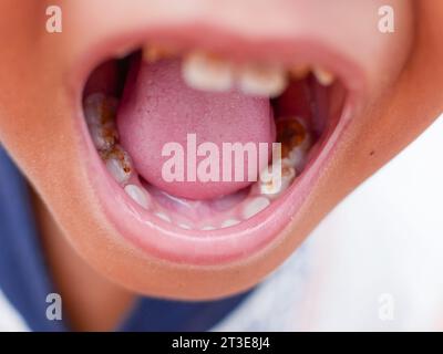 Nahaufnahme des offenen Mundes eines schwarzen Jungen mit Karies an den Zähnen. Gesundheit und zahnärztliche Versorgung Stockfoto